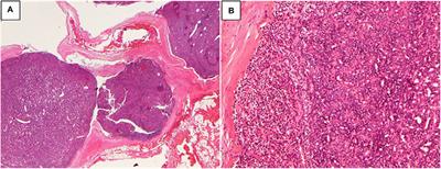 Prevalence of Parathyroid Carcinoma and Atypical Parathyroid Neoplasms in 153 Patients With Multiple Endocrine Neoplasia Type 1: Case Series and Literature Review